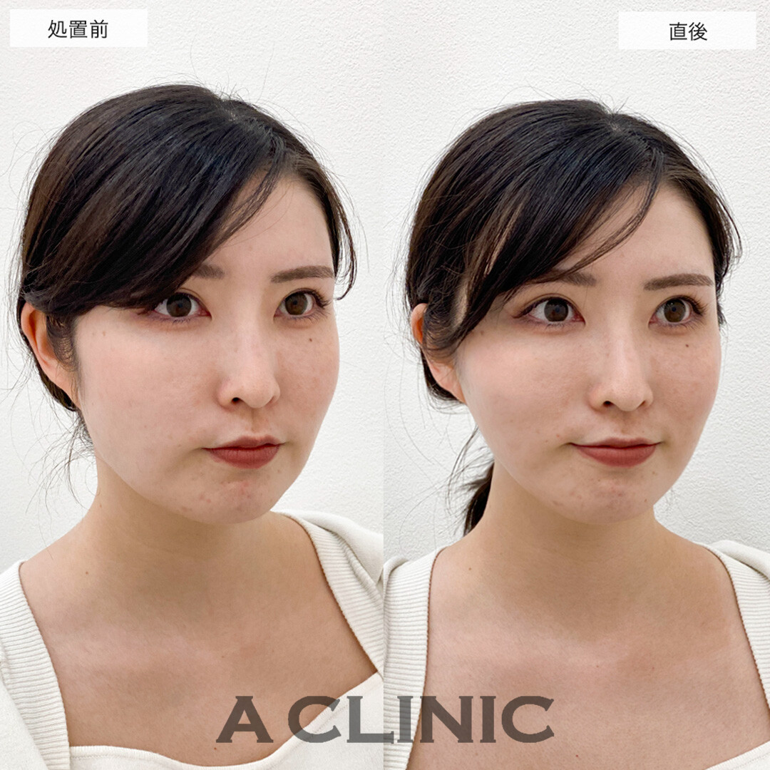 Aスレッドで輪郭のもたつきが引き上がり中顔面短縮!こちら処置前と直後の症例です(20代女性)