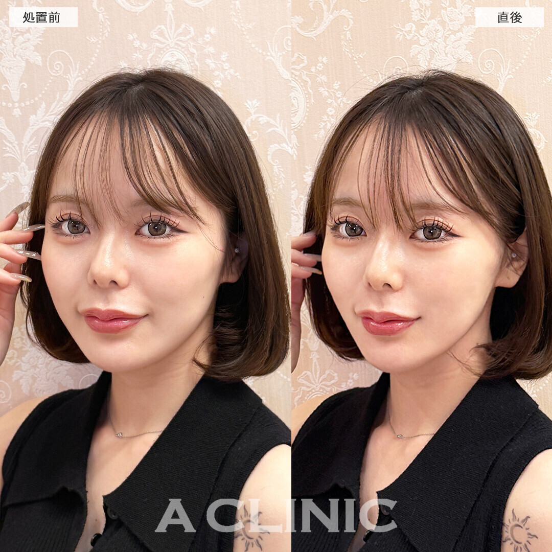 Aスレッドでひと回りスッキリ見える小顔になりました！こちら処置前と直後の症例です(20代女性)