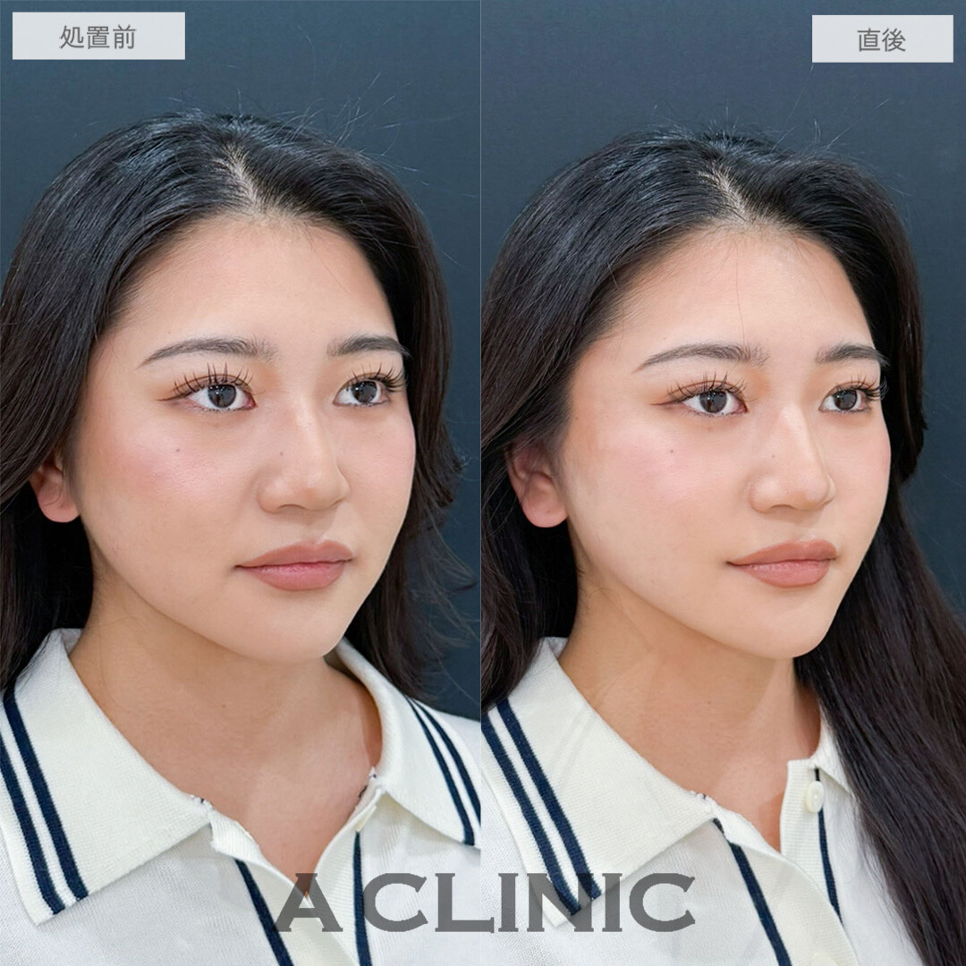 Aスレッドの定期的なメンテナンスで常に小顔に！こちら処置前と直後の症例です(20代女性)