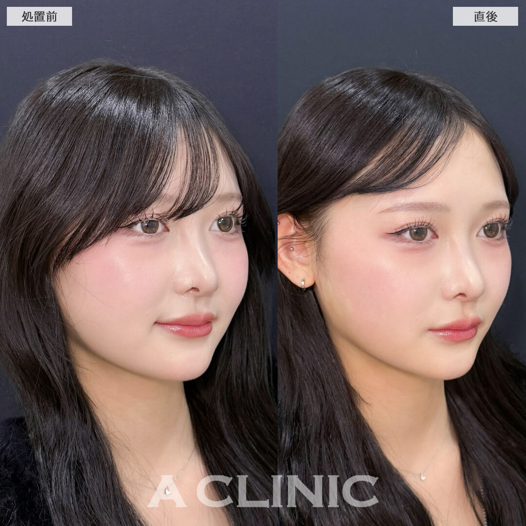 Aスレッドで理想のVフェイスを叶えられます！こちら処置前と直後の症例です(10代女性)