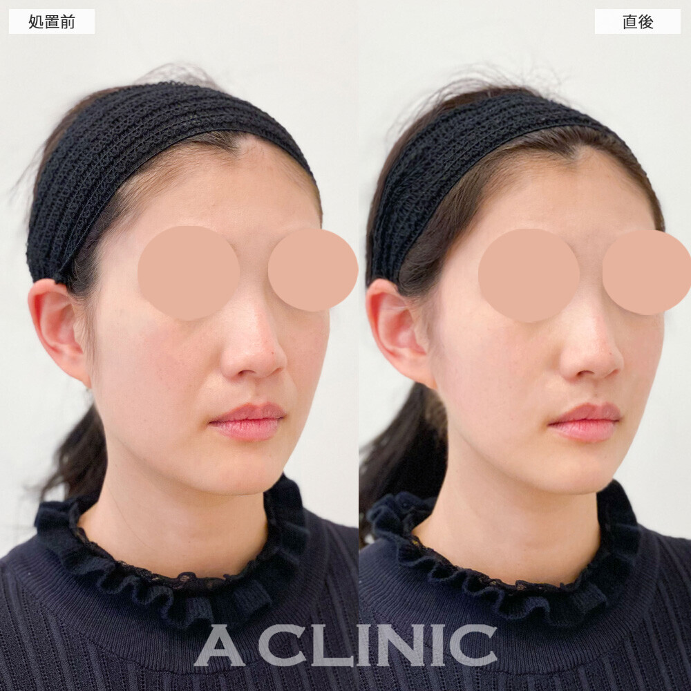 Aスレッドで顔の横幅狭くなり綺麗なVフェイスに！こちら処置前と直後の症例です(30代女性)