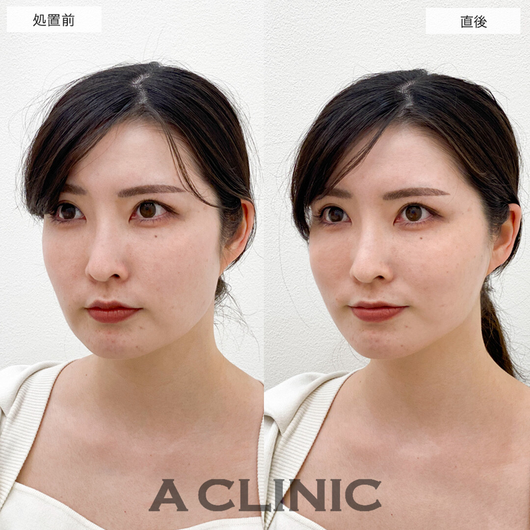 Aスレッドで輪郭のもたつきが引き上がり中顔面短縮!こちら処置前と直後の症例です(20代女性)