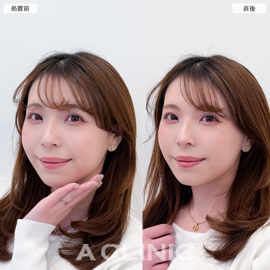 Aスレッドは不自然にならずに小顔になれます！こちら処置前と直後の症例です(30代女性)