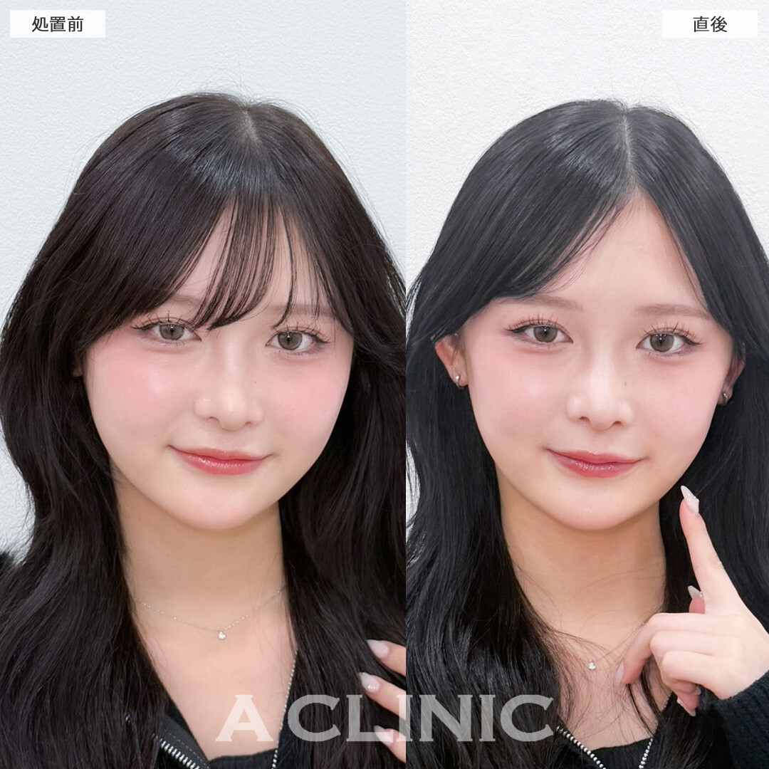Aスレッドで理想のVフェイスを叶えられます！こちら処置前と直後の症例です(10代女性)
