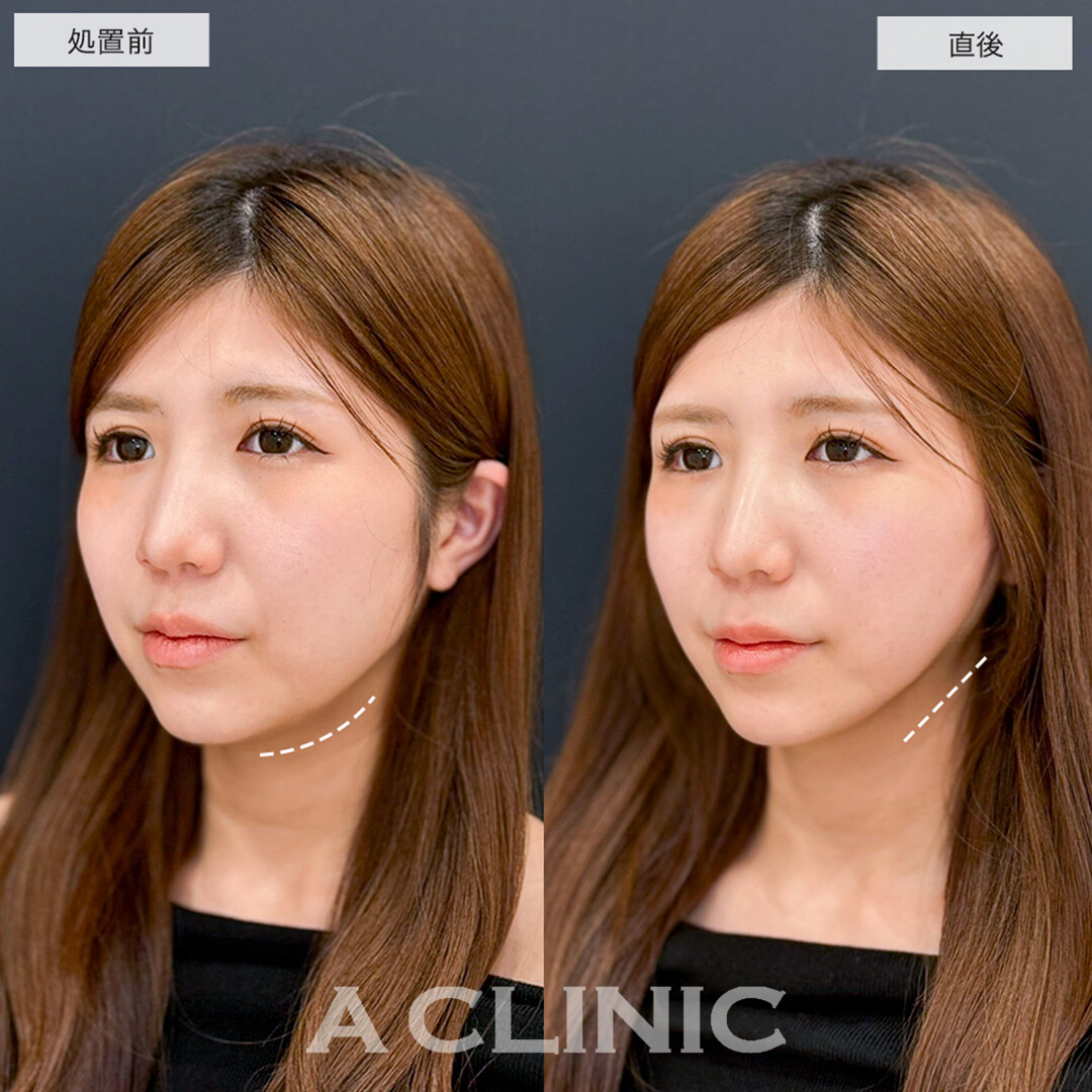 Aスレッドで即日理想の逆三角形の輪郭に!こちら処置前と直後の症例です(20代女性)