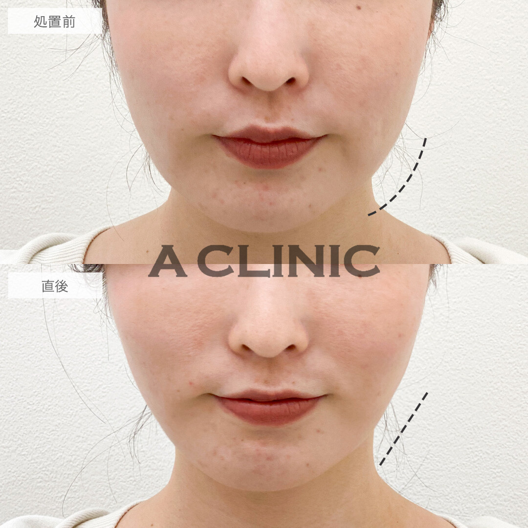 Aスレッドで輪郭のもたつきが引き上がり中顔面短縮!こちら処置前と直後の症例です(20代女性)