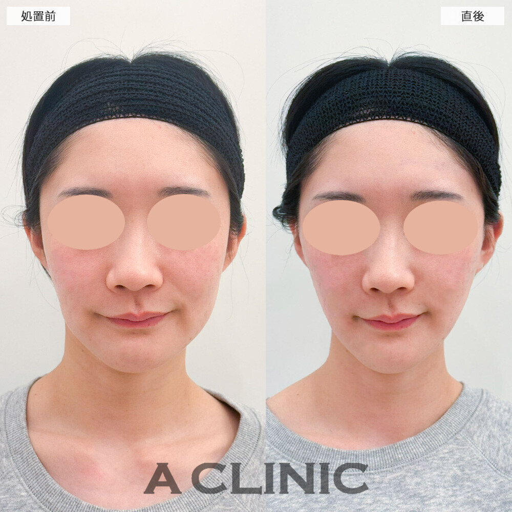 Aスレッドとエッグフェイスで頬コケを無くしながらリフトアップ！こちら処置前と直後の症例です(20代女性)
