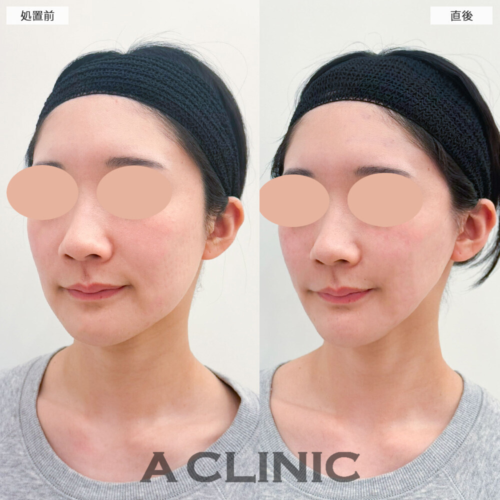 Aスレッドとエッグフェイスで頬コケを無くしながらリフトアップ！こちら処置前と直後の症例です(20代女性)
