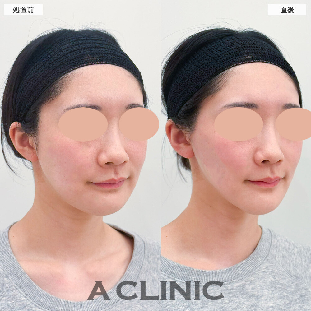 Aスレッドとエッグフェイスで頬コケを無くしながらリフトアップ！こちら処置前と直後の症例です(20代女性)