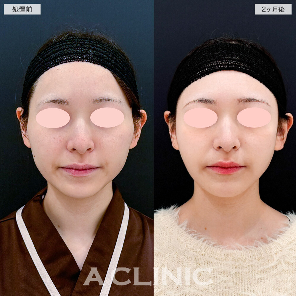 Aスレッドとバッカルファット除去術の併用で頬の厚みを抑えてナチュラルにリフトアップ！処置前と2ヶ月後の症例です(20代女性)