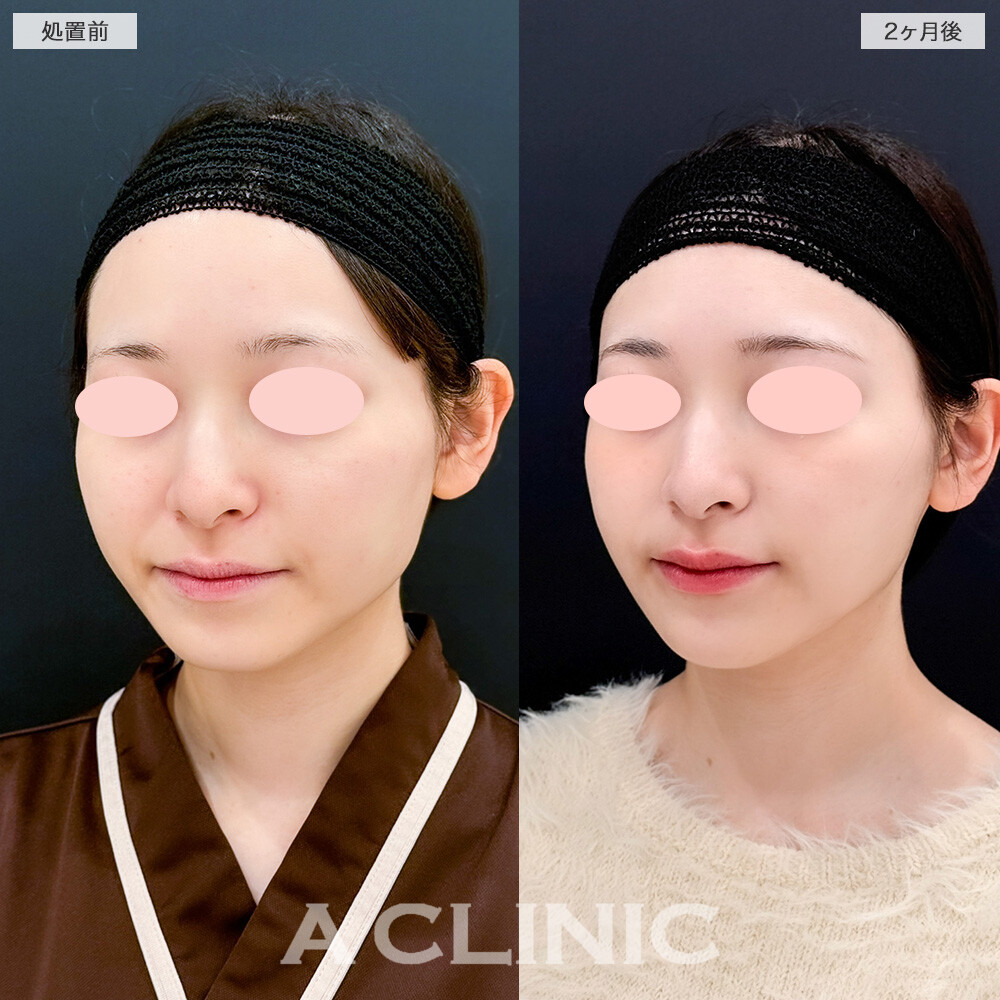 Aスレッドとバッカルファット除去術の併用で頬の厚みを抑えてナチュラルにリフトアップ！処置前と2ヶ月後の症例です(20代女性)