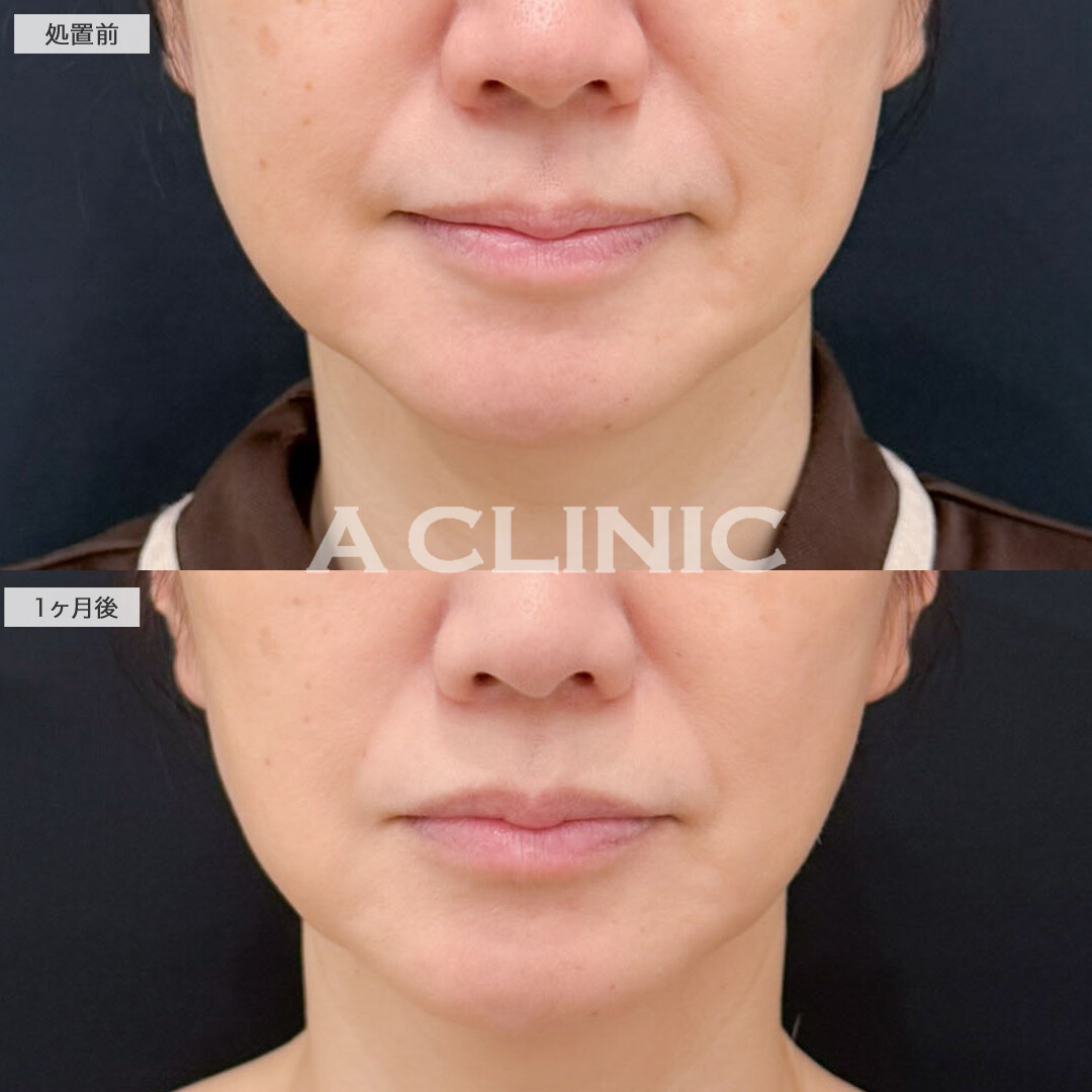 バッカルファット除去術とAスレッドで下がってきた脂肪を無くすことができました！こちら処置前と1ヶ月後の症例です(40代女性)