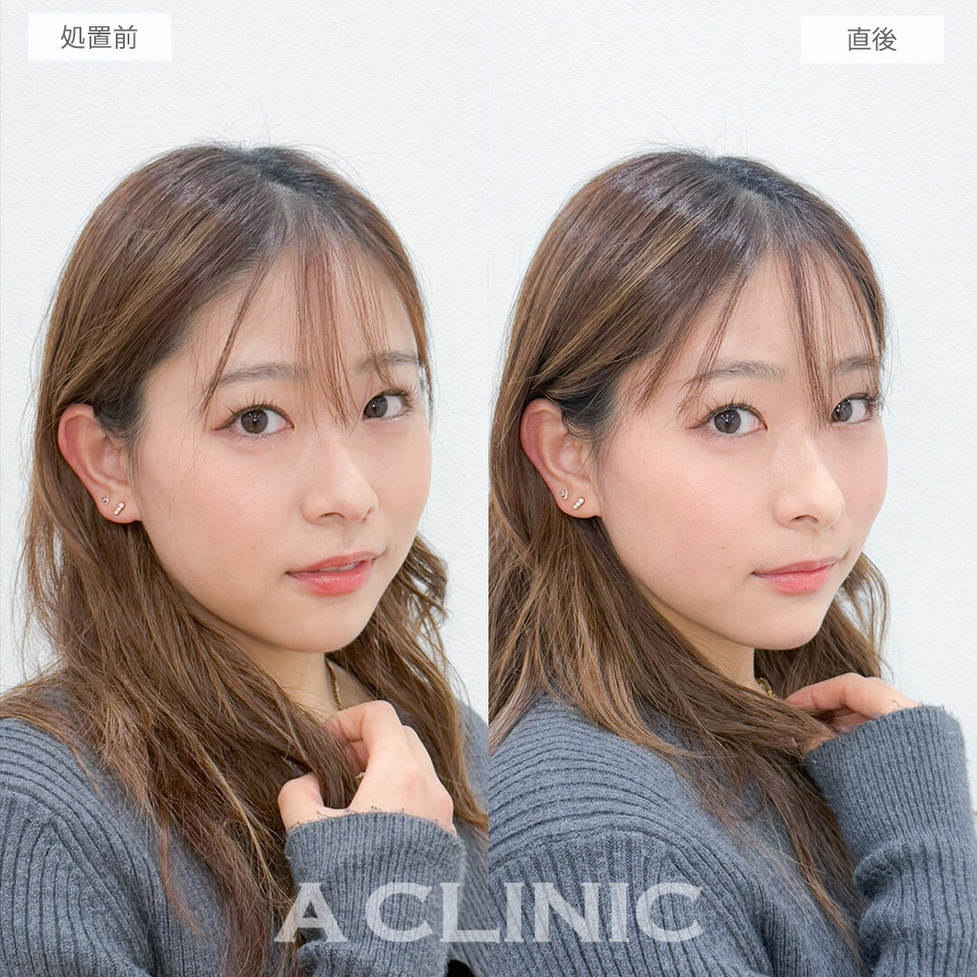ヒアルロン酸カスタマイズメニューでその日のうちにお顔の印象をガラッと変えられます！処置前と直後の症例です(20代女性)