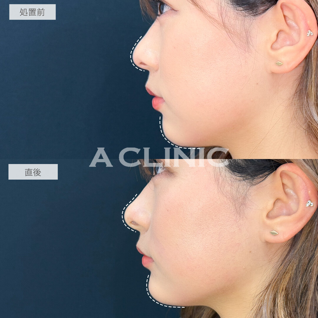 ヒアルロン酸カスタマイズメニューでその日のうちにお顔の印象をガラッと変えられます！処置前と直後の症例です(20代女性)