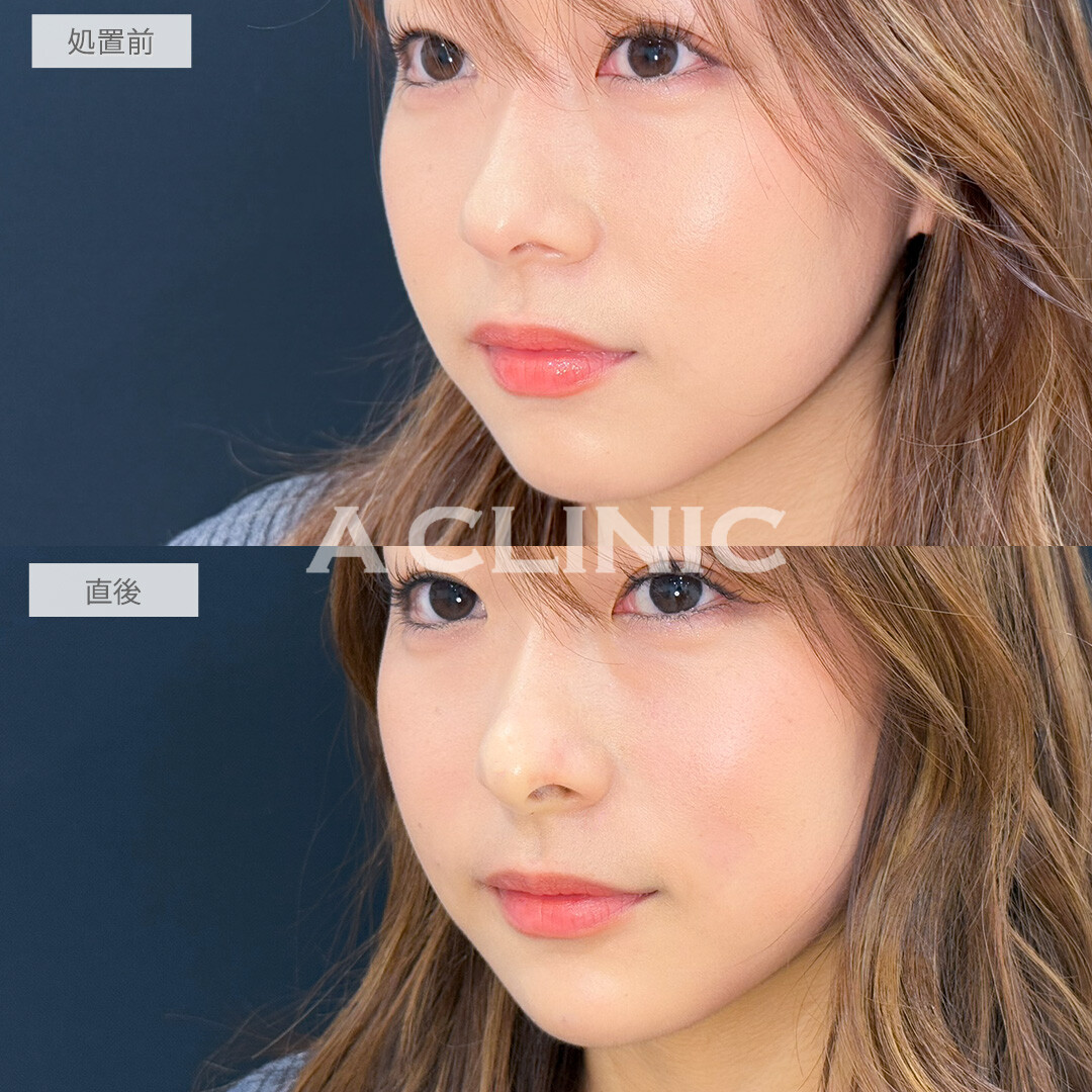 ヒアルロン酸カスタマイズメニューでその日のうちにお顔の印象をガラッと変えられます！処置前と直後の症例です(20代女性)