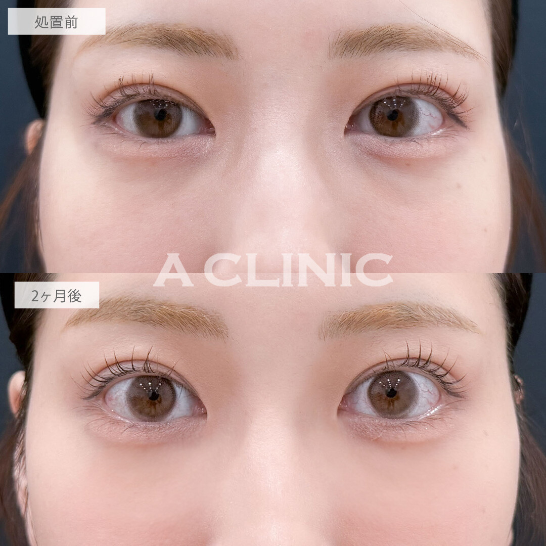 ヒアルロン酸カスタマイズメニューでさりげなくお顔全体の印象を変えられます！こちら処置前と2ヶ月後の症例です(20代女性)