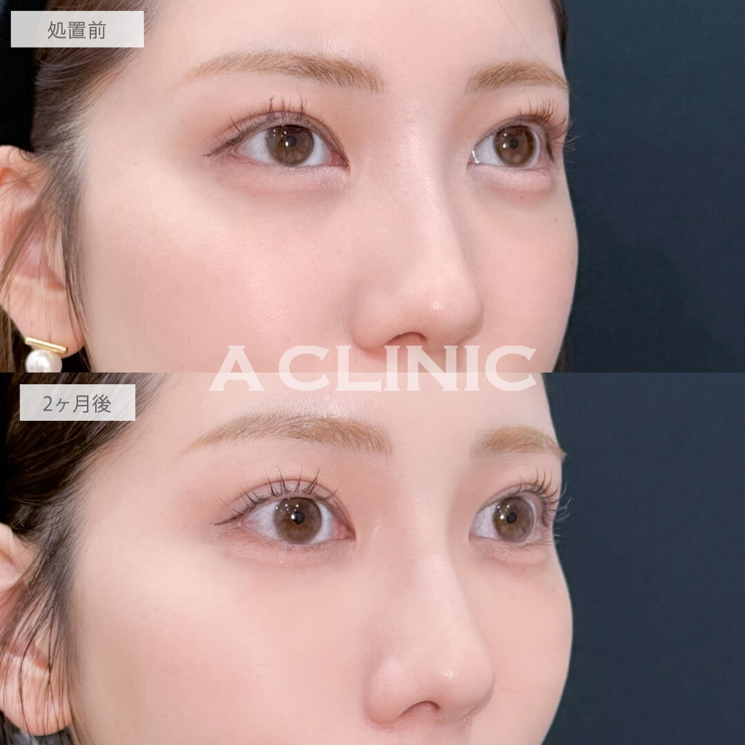 ヒアルロン酸カスタマイズメニューでさりげなくお顔全体の印象を変えられます！こちら処置前と2ヶ月後の症例です(20代女性)