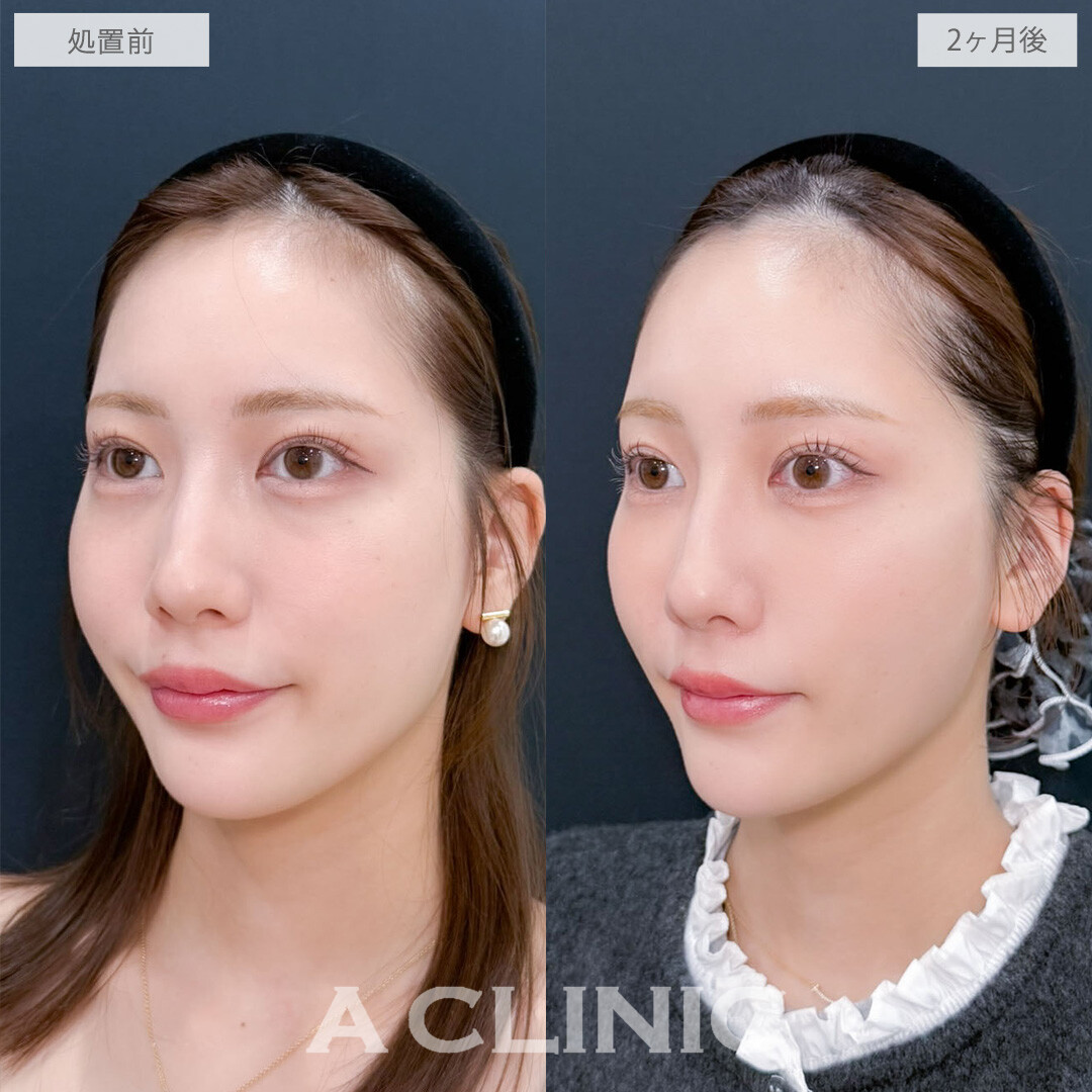 ヒアルロン酸カスタマイズメニューでさりげなくお顔全体の印象を変えられます！こちら処置前と2ヶ月後の症例です(20代女性)