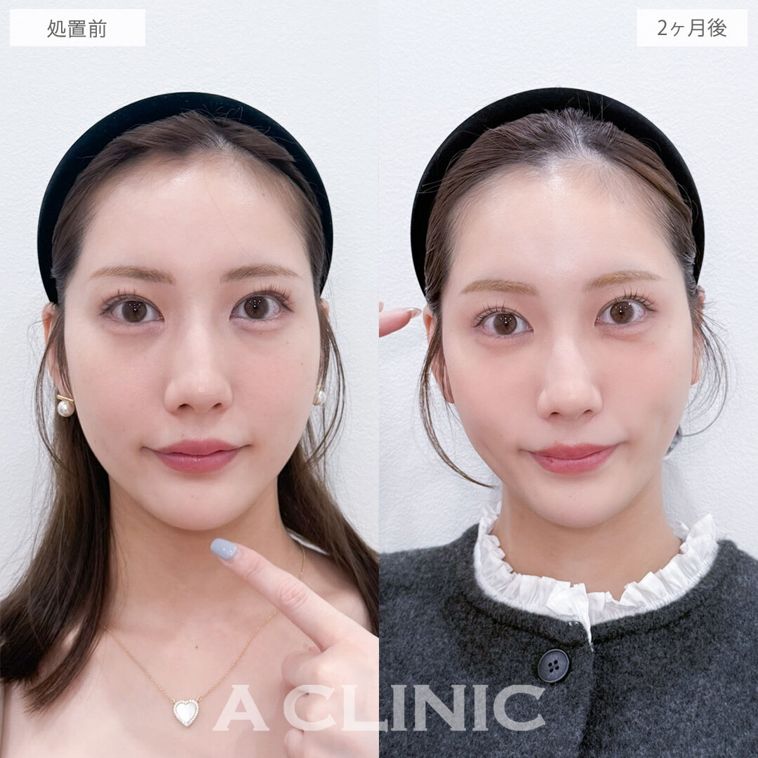 ヒアルロン酸カスタマイズメニューでさりげなくお顔全体の印象を変えられます！こちら処置前と2ヶ月後の症例です(20代女性)