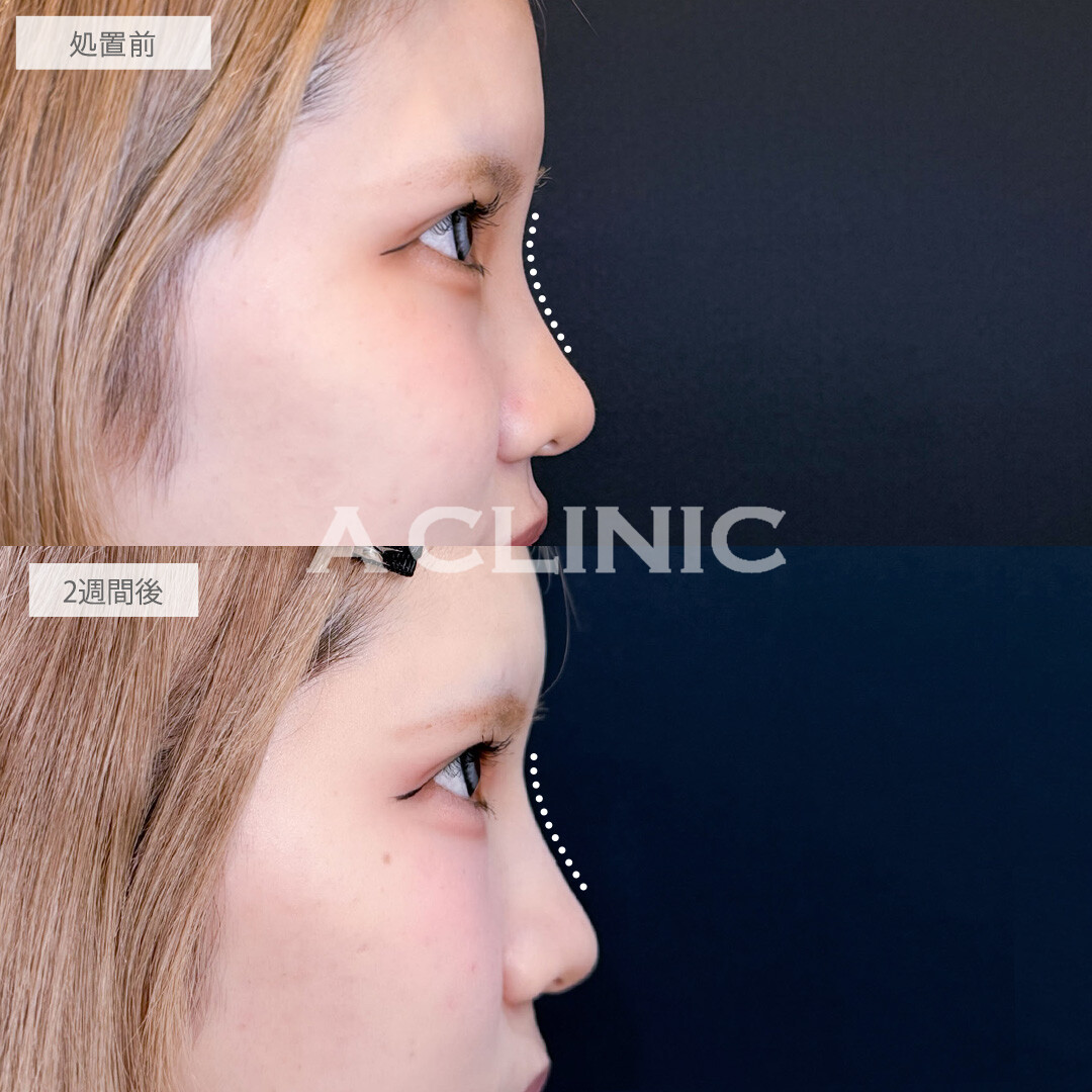 ヒアルロン酸カスタマイズメニューは注入だけでお顔の雰囲気をガラッと変えられます！こちら処置前と2週間後の症例です(20代女性)