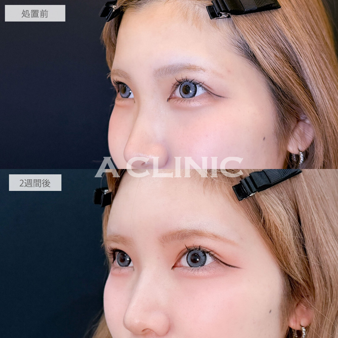 ヒアルロン酸カスタマイズメニューは注入だけでお顔の雰囲気をガラッと変えられます！こちら処置前と2週間後の症例です(20代女性)