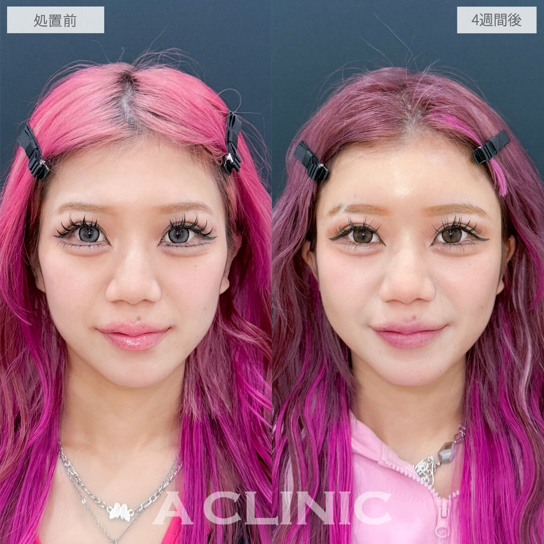 ヒアルロン酸カスタマイズメニューで凹みを埋めて女性らしい印象に！こちら処置前と4週間後の症例です(20代女性)