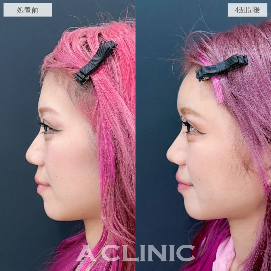 ヒアルロン酸カスタマイズメニューで凹みを埋めて女性らしい印象に！こちら処置前と4週間後の症例です(20代女性)