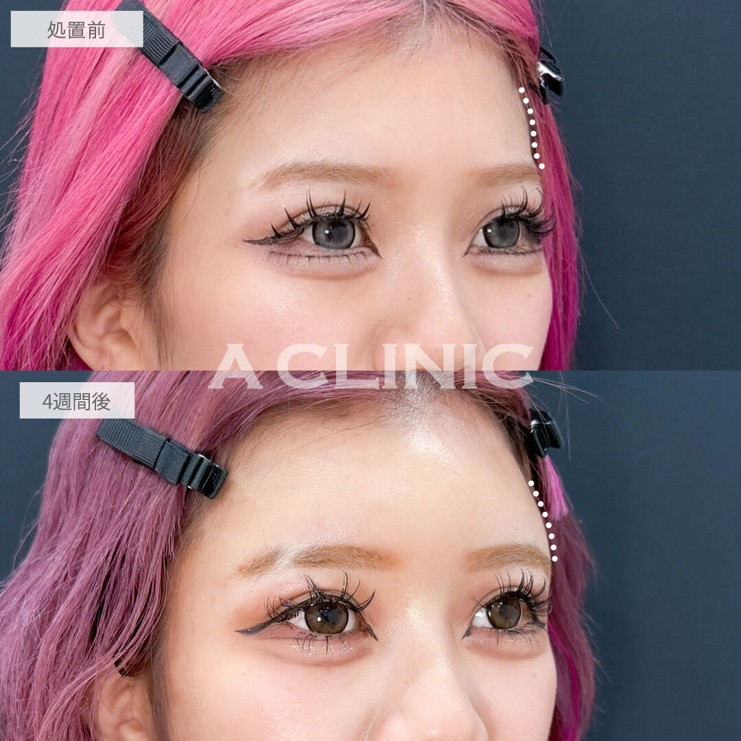 ヒアルロン酸カスタマイズメニューで凹みを埋めて女性らしい印象に！こちら処置前と4週間後の症例です(20代女性)