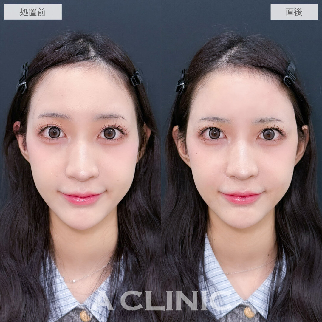 ヒアルロン酸カスタマイズメニューはナチュラルに可愛くなれる施術です！こちら処置前と直後の症例です(20代女性)