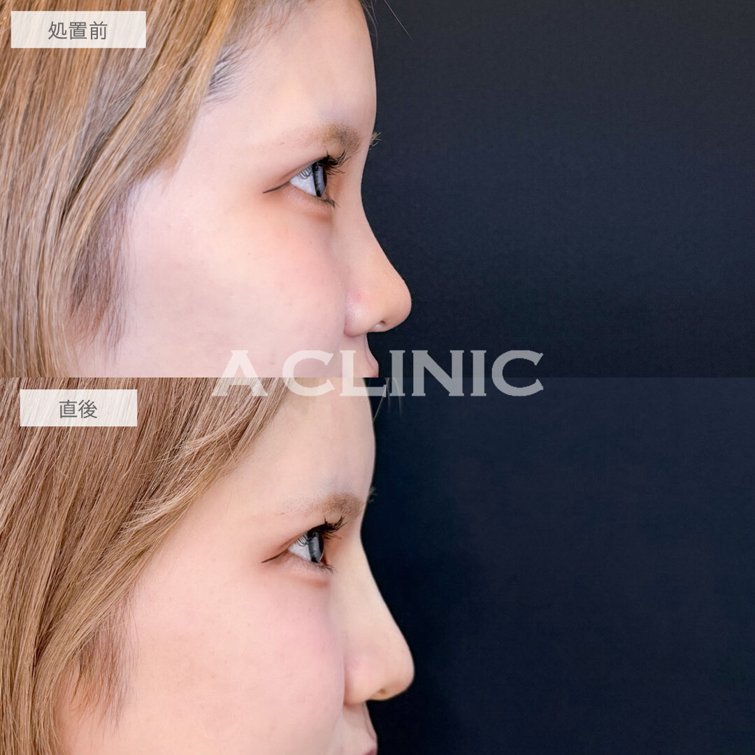 ヒアルロン酸カスタマイズメニューで額も鼻も理想の形に！こちら処置前と直後の症例です(20代女性)