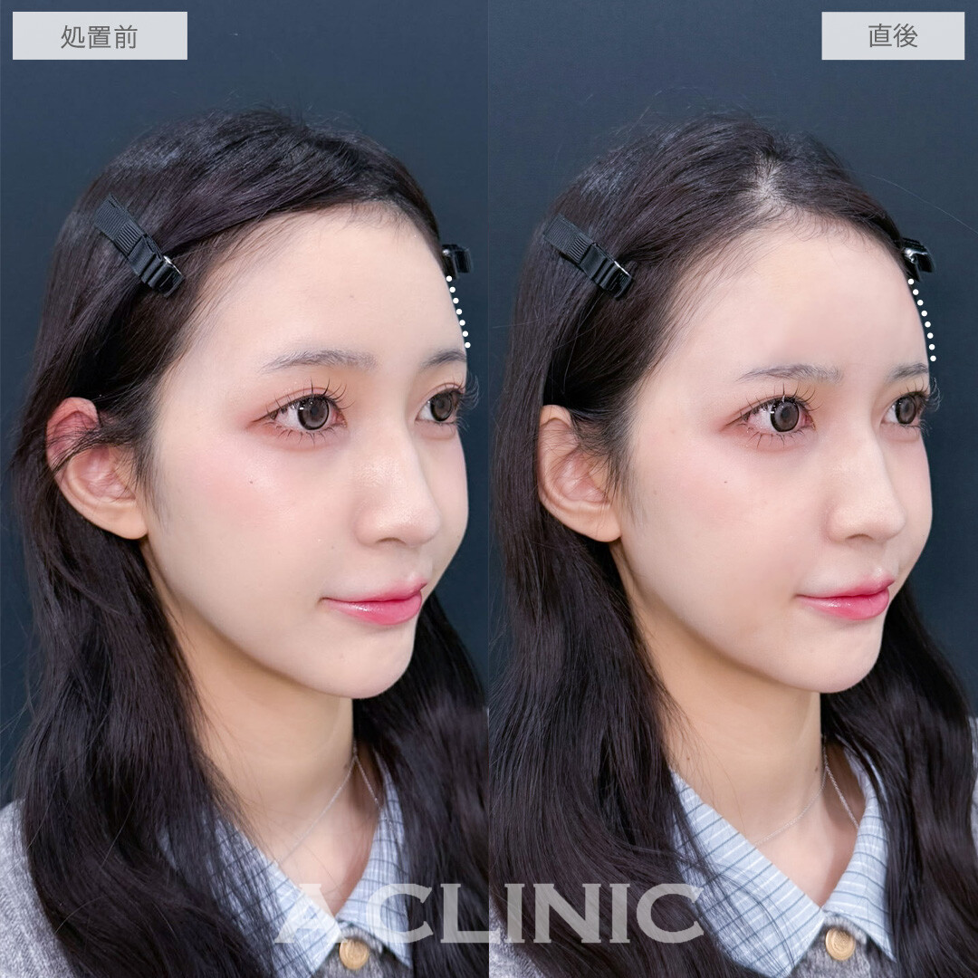 ヒアルロン酸カスタマイズメニューはナチュラルに可愛くなれる施術です！こちら処置前と直後の症例です(20代女性)