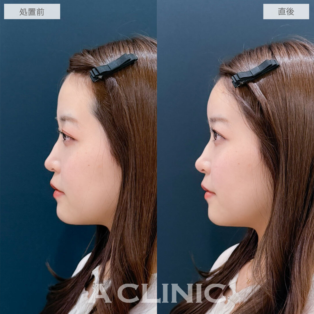 ヒアルロン酸カスタマイズメニューでお顔のお悩みを一度で改善できます！こちら処置前と直後の症例です(20代女性)