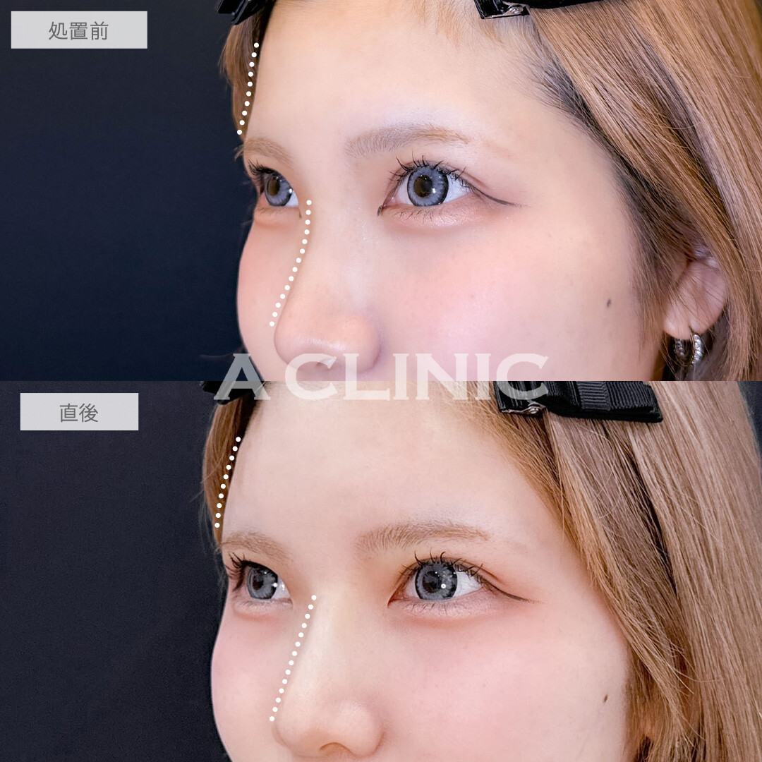 ヒアルロン酸カスタマイズメニューで額も鼻も理想の形に！こちら処置前と直後の症例です(20代女性)