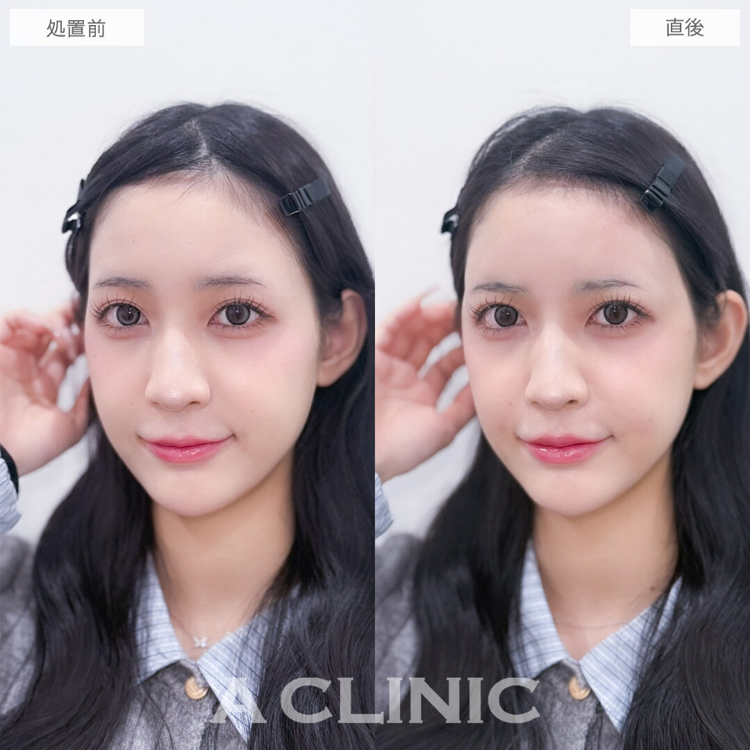 ヒアルロン酸カスタマイズメニューはナチュラルに可愛くなれる施術です！こちら処置前と直後の症例です(20代女性)