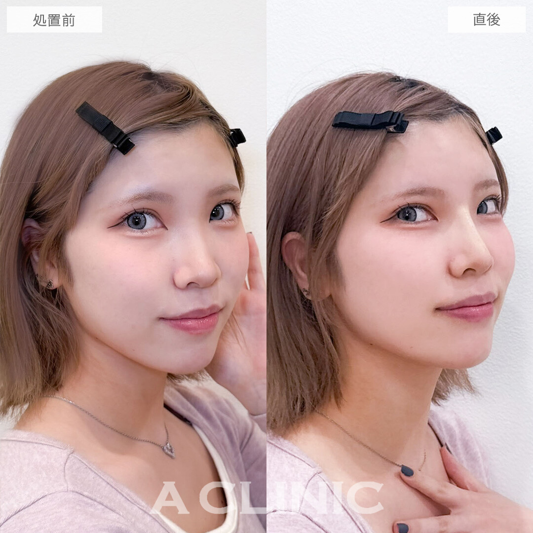 ヒアルロン酸カスタマイズメニューで額も鼻も理想の形に！こちら処置前と直後の症例です(20代女性)