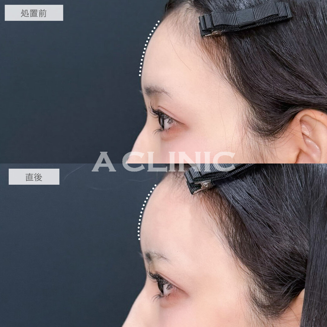 ヒアルロン酸カスタマイズメニューはナチュラルに可愛くなれる施術です！こちら処置前と直後の症例です(20代女性)