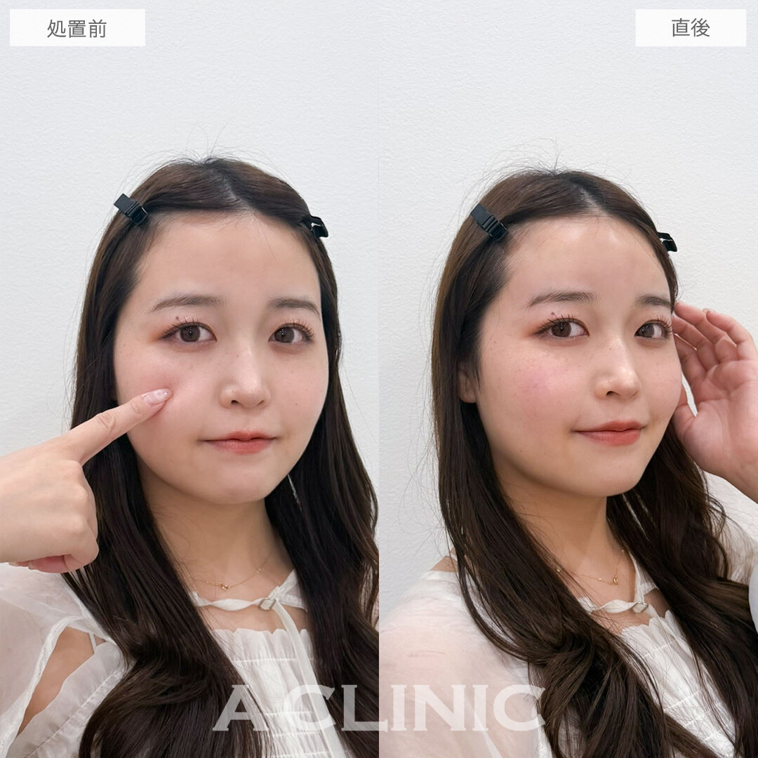 ヒアルロン酸カスタマイズメニューでお顔のお悩みを一度で改善できます！こちら処置前と直後の症例です(20代女性)
