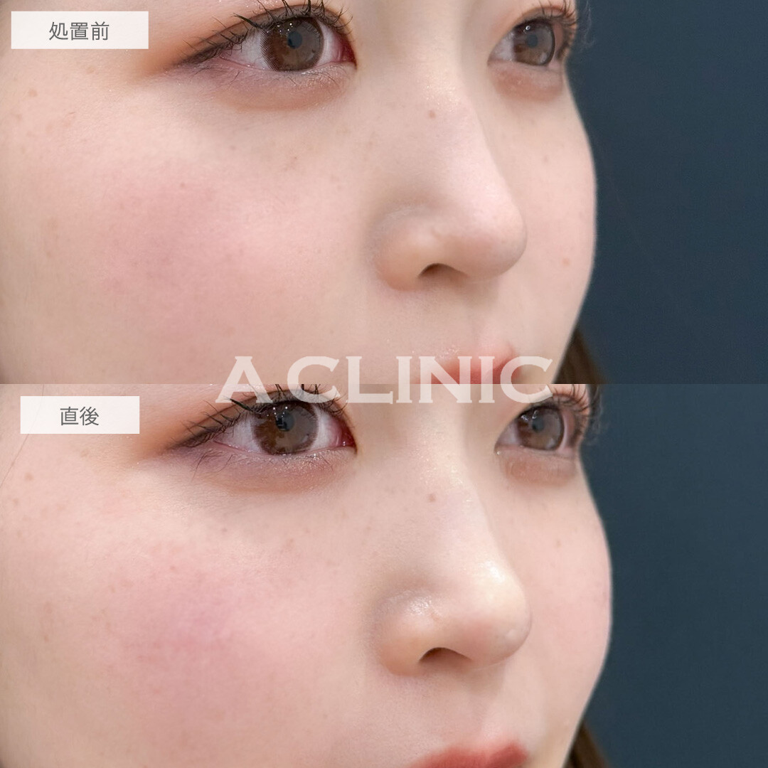 ヒアルロン酸カスタマイズメニューでお顔のお悩みを一度で改善できます！こちら処置前と直後の症例です(20代女性)