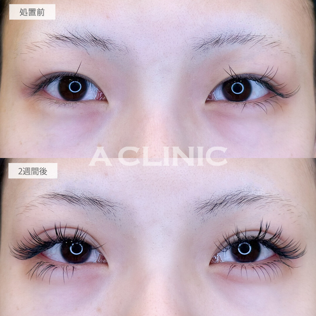 ドーリーアイズでメイク映えする目元に！処置前と2週間後の症例です(10代女性)