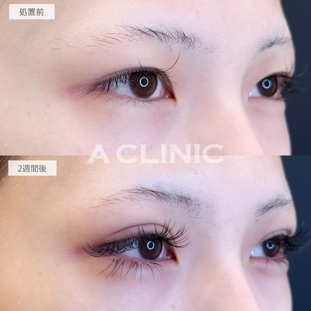 ドーリーアイズでメイク映えする目元に！処置前と2週間後の症例です(10代女性)