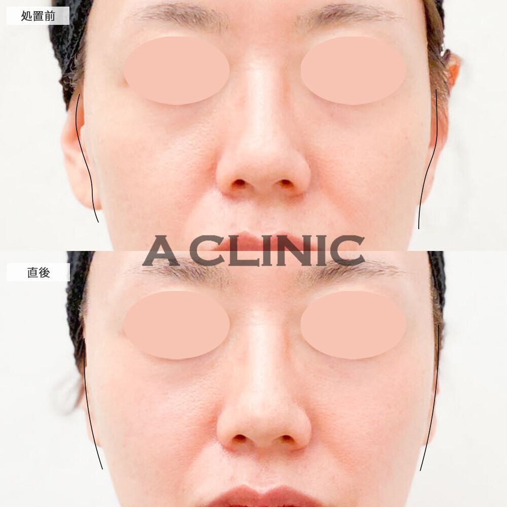 エッグフェイスで頬の凹凸感が綺麗に整いました！こちら処置前と直後の症例です(40代女性)