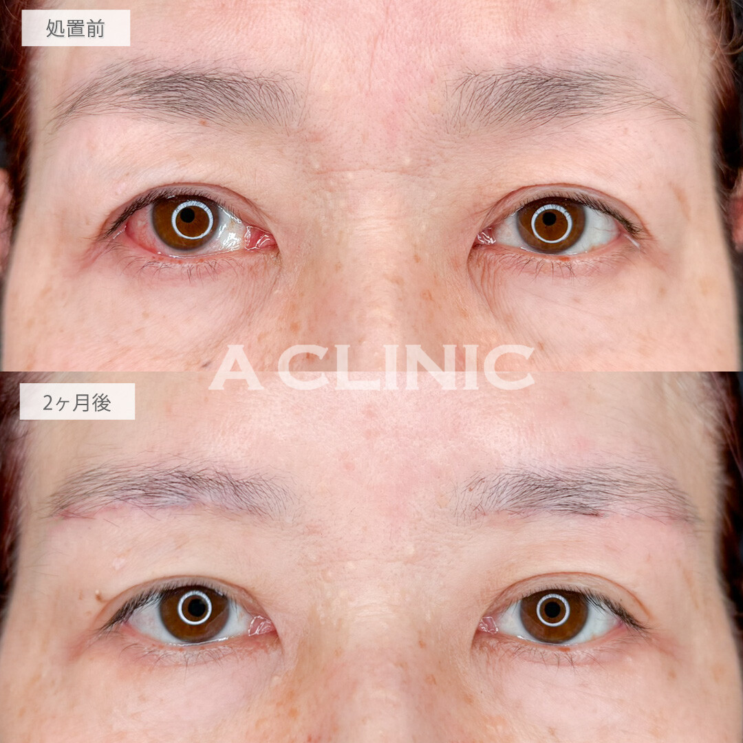 眉下リフトでたれ下がった目元も若々しいパッチリ目になりました！処置前と2ヶ月後の症例です(50代女性)