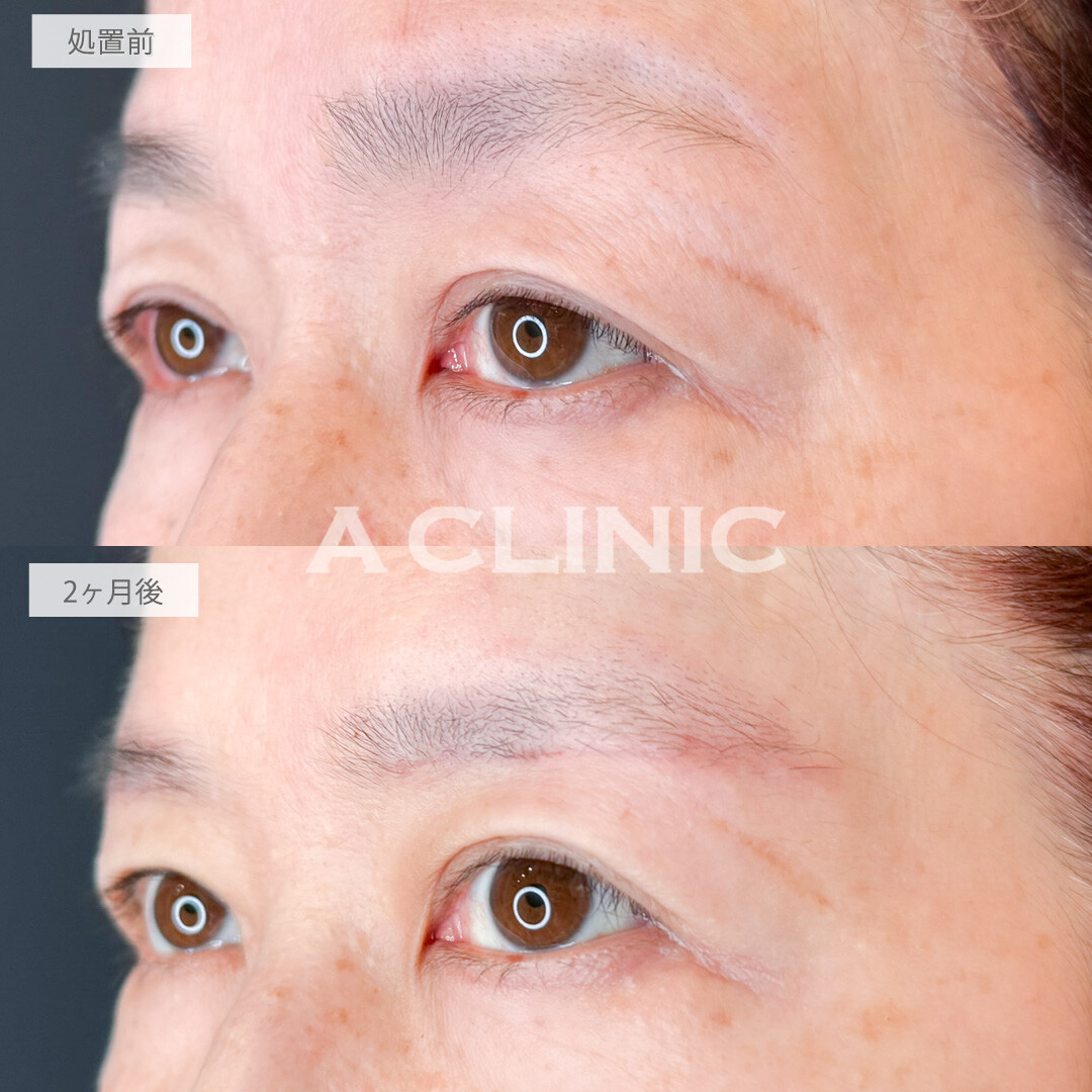眉下リフトでたれ下がった目元も若々しいパッチリ目になりました！処置前と2ヶ月後の症例です(50代女性)