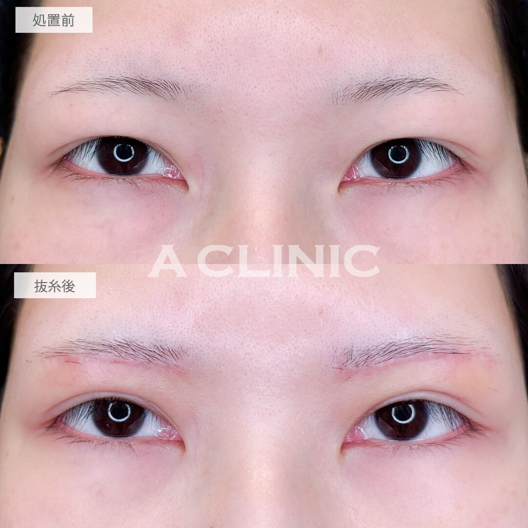 眉下リフトで目の上の重たさが解消されて瞼で隠れていた二重がくっきりしました！処置前と抜糸後の症例です(20代女性)