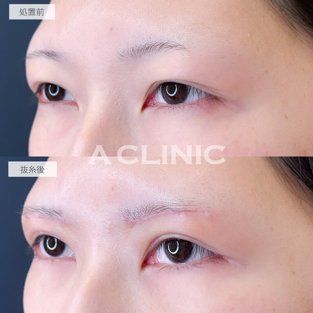 眉下リフトで目の上の重たさが解消されて瞼で隠れていた二重がくっきりしました！処置前と抜糸後の症例です(20代女性)