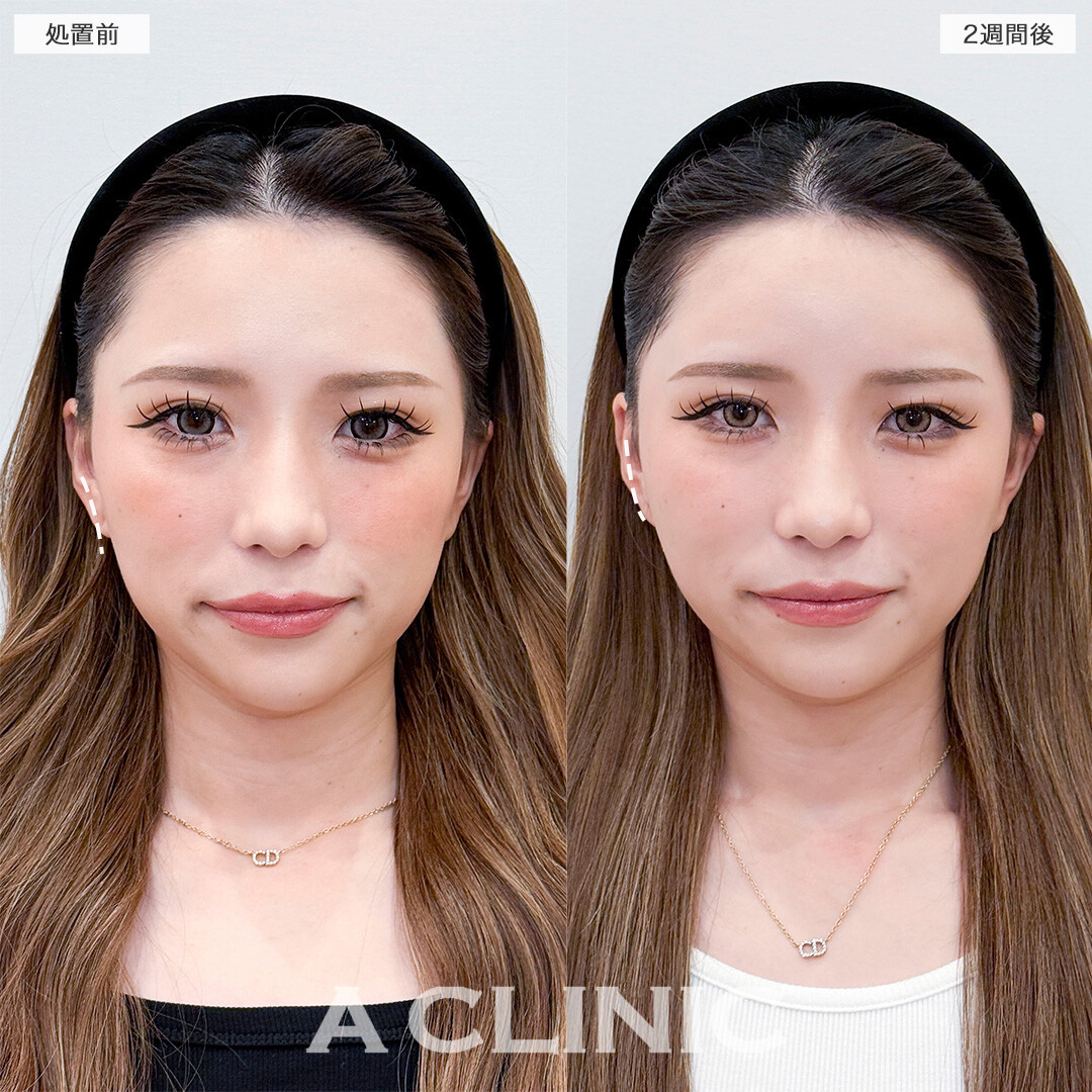 ヒアルロン酸カスタマイズメニューでつるんと丸い額を手に入れました！処置前と2週間後の症例です(20代女性)