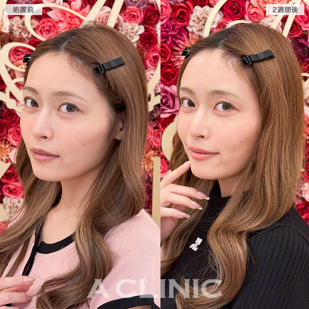 ヒアルロン酸カスタマイズメニューで全体のバランスを整え垢抜け！処置前と2週間後の症例です(30代女性)