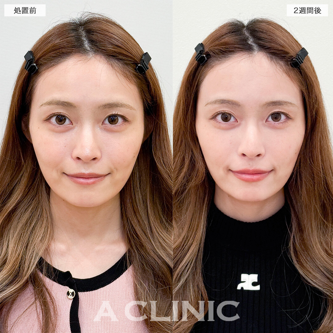 ヒアルロン酸カスタマイズメニューで全体のバランスを整え垢抜け！処置前と2週間後の症例です(30代女性)