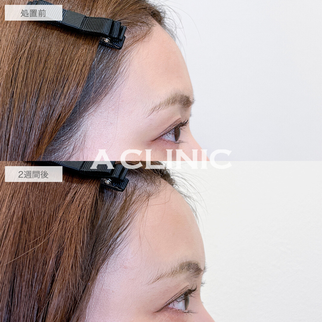 ヒアルロン酸カスタマイズメニューで全体のバランスを整え垢抜け！処置前と2週間後の症例です(30代女性)