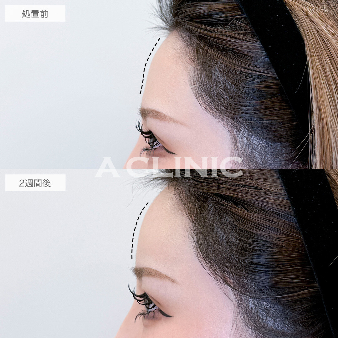 ヒアルロン酸カスタマイズメニューでつるんと丸い額を手に入れました！処置前と2週間後の症例です(20代女性)